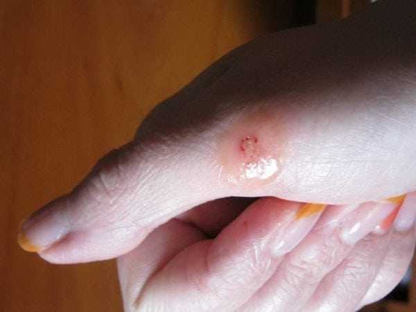 БФ-6 на руке БФ-6 используется для обработки порезов и ссадин